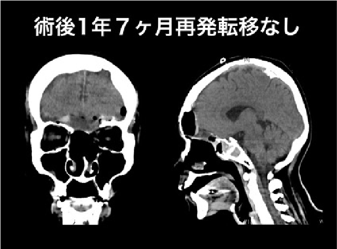 術後1年7ヶ月再発転移なし